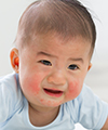 baby-face-rash