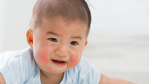 baby-face-rash